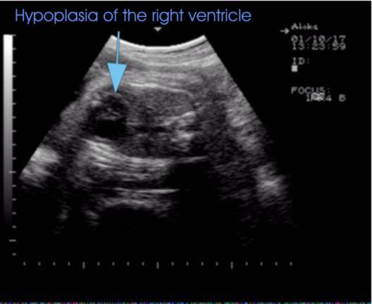 Fetal Ultrasound